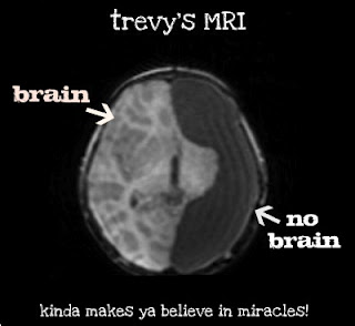 trevys MRI